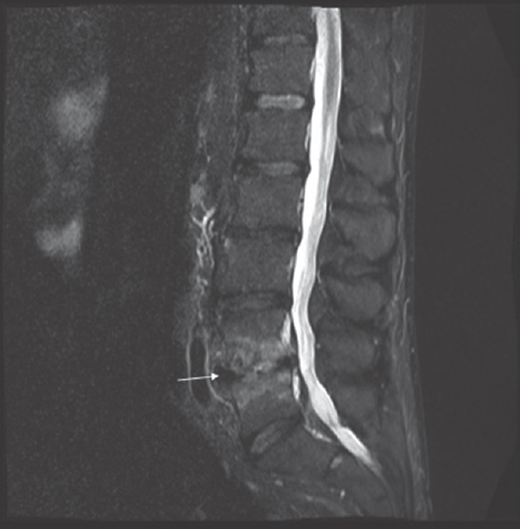 A 50-year-old male presented with chronic low back pain. Modic Type 1 endplate changes characterized by hyperintense signal (white arrow) on a sagittal short tau inversion recovery image of the lumbar spine.