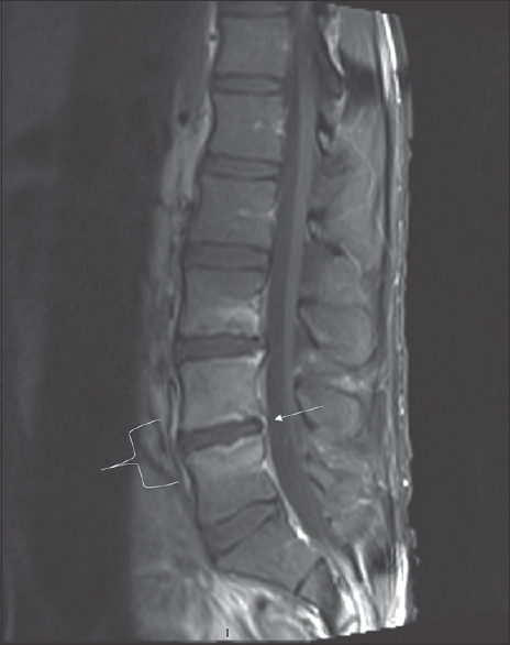 A 30-year-old male presented with fever, night sweats, weight loss, and severe low back pain. A fat, saturated T1 enhanced magnetic resonance imaging of the lumbar spine demonstrates enhancement of the L4 and L5 endplates (white bracket) with subligamentous enhancement posteriorly (white arrow). There is also enhancement of the L3 inferior endplate. Biopsy cultures revealed atypical mycobacterial infection.