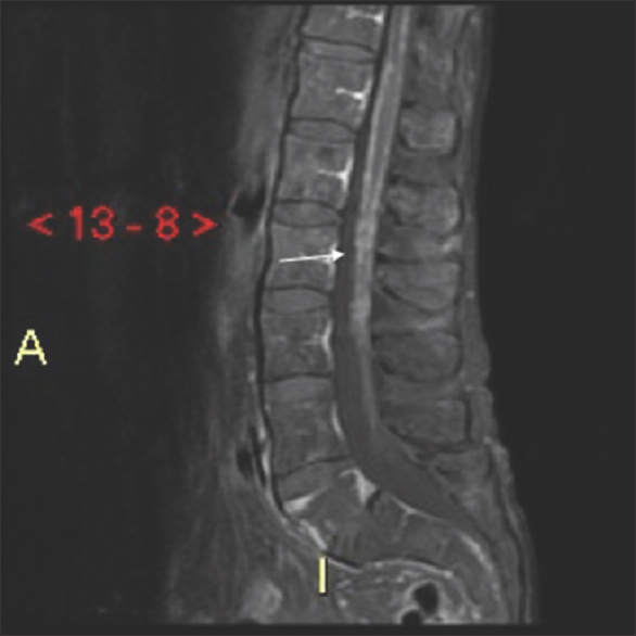 A 59-year-old male presented with progressive bilateral lower extremity weakness, cough, and malaise Sagittal T1 fat, saturated magnetic resonance imaging of the lumbar spine demonstrates thin micronodular enhancement of the surface of the spinal cord. Further patient workup revealed metastatic lung cancer.