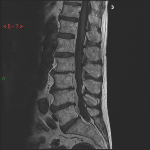 A 68-year-old male presented with severe low back pain and altered bilateral lower extremity sensation after falling down. He was taking Plavix for a coronary stent. A sagittal T1 weighted magnetic resonance imaging of the lumbar spine demonstrates an anterior epidural hematoma from T12 through L5 (black arrow).