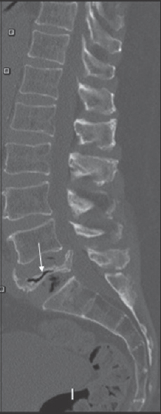 A 53-year-old male presented with severe low back pain. He was taking oral steroids. He denied trauma. An unenhanced sagittal computerized tomography image of the lumbar spine demonstrates a compression fracture of the L5 vertebral body with vertebra plana and retropulsion of bone into the spinal canal (white arrow).