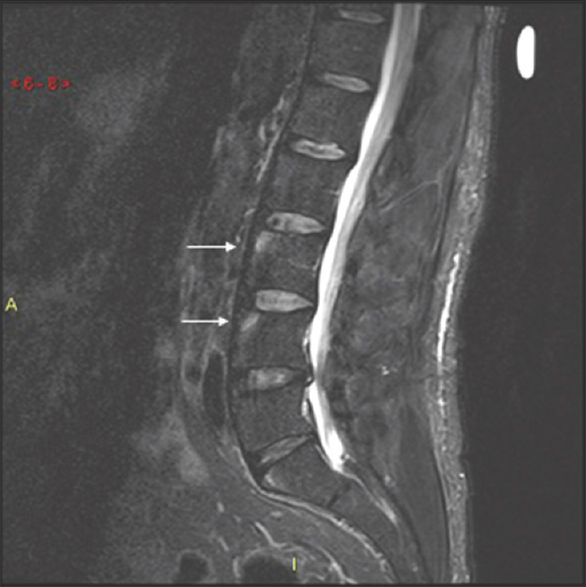 A 28-year-old male was imaged because of progressive worsening low back pain. A Sagittal short tau inversion recovery magnetic resonance imaging of the lumbar spine demonstrates Romanus lesions, also known as “shiny corners” at the anterior superior endplates of L3 and L4 (white arrows). Further workup revealed a diagnosis of ankylosing spondylitis.