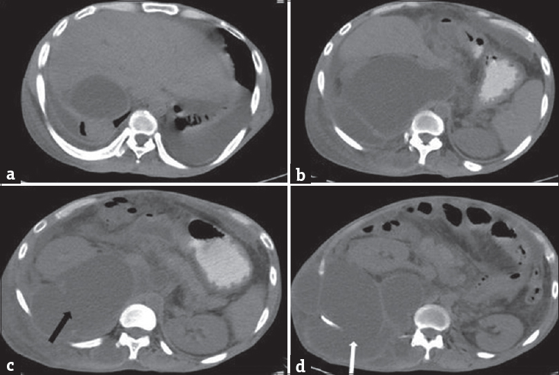 A 35-year-old male with acute-on-chronic pancreatitis with pseudocysts, who presented with abdominal pain and distention with lump in the right lateral abdominal wall. Plain computed tomography scan of the abdomen showing pseudocyst in the right posterior pararenal space (black arrow) extending into the right lumbar triangle (white arrow).