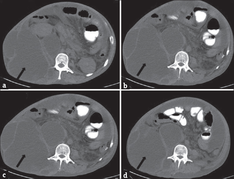 A 35-year-old male with acute-on-chronic pancreatitis with pseudocysts, who presented with abdominal pain and distention with lump in the right lateral abdominal wall. Plain computed tomography scan of the abdomen showing pseudocyst in the right lumbar triangle (black arrow).
