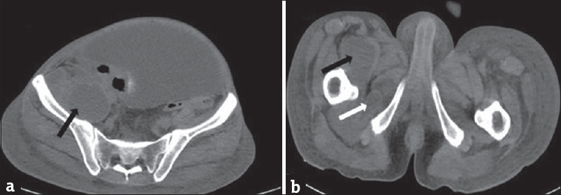 A 35-year-old male with acute-on-chronic pancreatitis with pseudocysts, who presented with abdominal pain and distention with lump in the right lateral abdominal wall. Plain computed tomography scan of the abdomen showing (a) pseudocyst in the right ilio-psoas (black arrow) and (b) right obturator externus (white arrow).