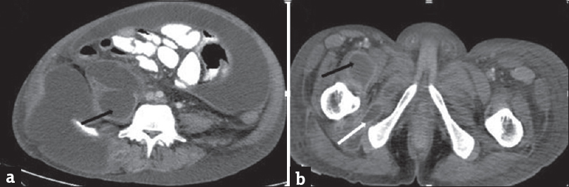 A 35-year-old male with acute-on-chronic pancreatitis with pseudocysts, who presented with abdominal pain and distention with lump in the right lateral abdominal wall. Contrast-enhanced computed tomography scan of the abdomen showing pseudocyst in the right psoas muscle (black arrow) and right obturator externus (white arrow).