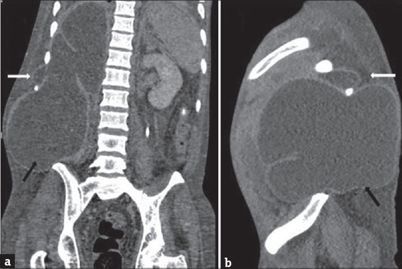 A 35-year-old male with acute-on-chronic pancreatitis with pseudocysts, who presented with abdominal pain and distention with lump in the right lateral abdominal wall. Coronal (a) and sagittal (b) computed tomography scan images showing pseudocyst in the right posterior pararenal space extending through the intercostal space (white arrow) and right lumbar triangle (black arrow).