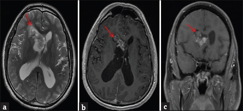 A 44-year-old male presented with complaints of hearing loss and gait instability. He was found to have a biopsy-proven pilocytic astrocytoma. Magnetic resonance imaging of the brain showed a mass in the right lateral ventricle. (a) Axial T2 sequence demonstrates heterogeneous mass (red arrow in A) within the anterior horn of the right lateral ventricle with associated mass effect and left-sided midline shift. (b) Axial T1 postcontrast images were obtained that demonstrated the intraventricular mass (red arrow in B) to have heterogeneous enhancement. (c) Coronal T1 postcontrast sequence demonstrates heterogeneous enhancement of the right intraventricular mass (red arrow in C) resulting in compression of the left lateral ventricle with mass effect.