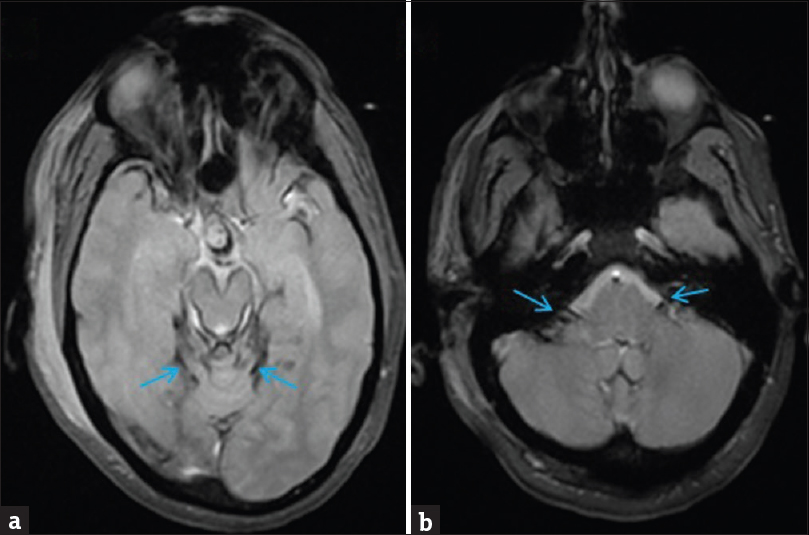 Forty-four-year-old male status postresection of pilocytic astrocytoma with persistent hearing loss and gait instability. Superficial siderosis was shown on imaging. magnetic resonance imaging brain: Axial T2*gradient-recalled echo sequences of the brain at the level of midbrain (a) and at the level of the pons (b) show superficial siderosis. (a) Axial T2*gradient-recalled echo sequence at the level of the midbrain demonstrates susceptibility along the medial aspect of the temporal lobes bilaterally, specifically involving the hippocampus (blue arrow). (b) Axial T2*gradient-recalled echo sequence at the level of the cerebellum shows susceptibility along the vestibulocochlear nerve and facial nerve bilaterally, extending to the level of the internal acoustic meatus (blue arrow).