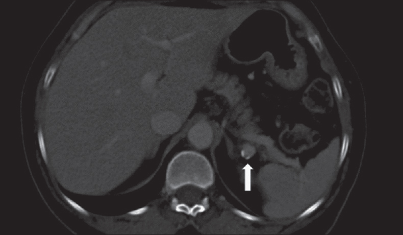 A 50-year-old male presenting with altered bowel habit. Contrast-enhanced computed tomography of upper abdomen shows incidental splenic artery aneurysm with peripheral calcification (arrow).