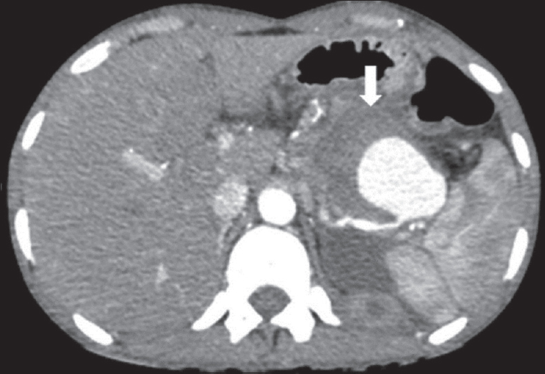 A 40-year-old male with chronic pancreatitis presenting with abdominal pain. Contrast-enhanced computed tomography of upper abdomen shows partially thrombosed (arrow) saccular aneurysm arising from the distal third of the splenic artery.