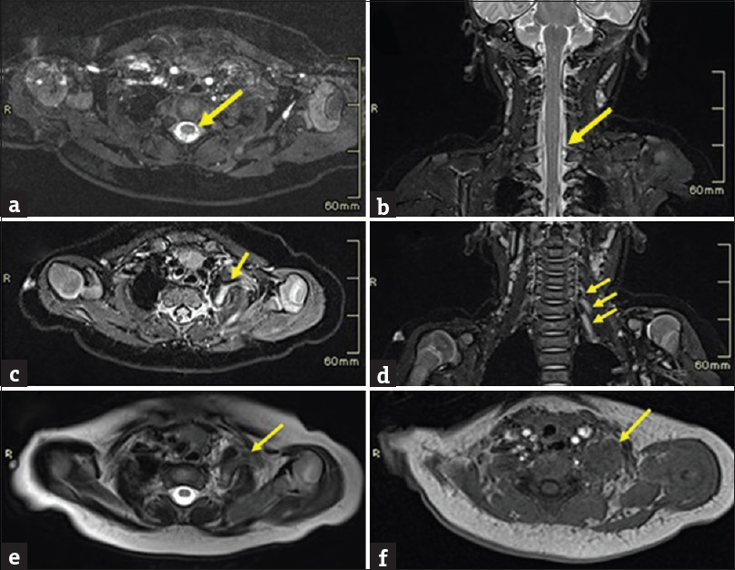 A case of left brachial plexus birth palsy. Images (a-f) show MRI of brachial plexus in a three-month-old infant. (a, b) Axial T2W CISS sequence and Coronal T2W image shows thecal sac without pseudomeningocele. (c) Axial STIR image shows thickening and increased signals from C5 cervical nerve (arrow) on the left side. (d) Coronal STIR image shows increased signals from the C5, C6 and C7 cervical nerves (arrow) on the left side. (e) Axial T2W image shows swelling of left scalene muscles with an abnormal T2 bright (arrow) periscalene signal. (f) Axial T1W images show isointense signal giving a mass like appearance (arrow).