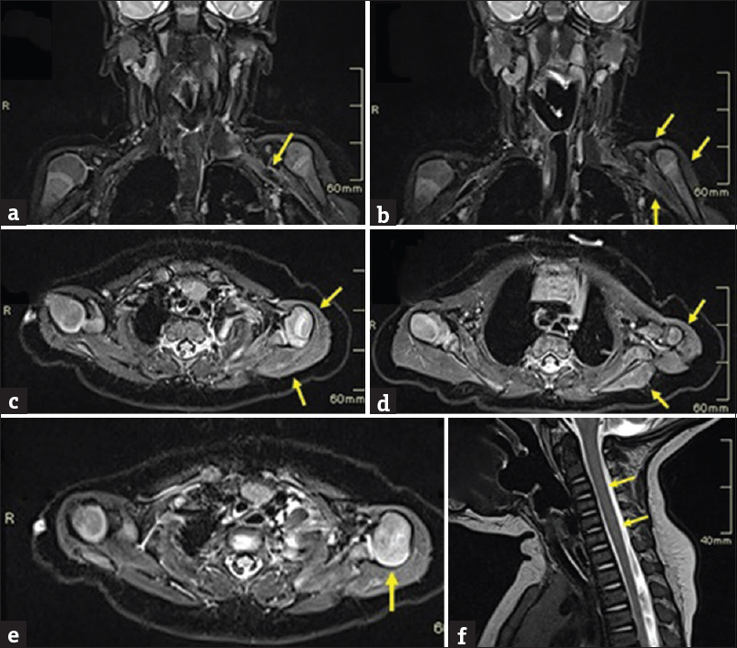 A case of left brachial plexus birth palsy. Image (a-f) shows MRI of brachial plexus in a three-month-old infant with a postganglionic injury and musculoskeletal abnormalities. (a) Coronal STIR image shows generalized thickening of left brachial plexus (arrow) beyond lateral border of the first rib. (b, c & d) Coronal and Axial STIR images showing diffuse swelling and increased signals involving the shoulder girdle muscles (arrows). (e) Axial STIR image shows posterior subluxation of the humeral head (arrow). (f) Sagittal T2W image shows no abnormal signal intensity lesions in the cervicothoracic spinal cord (arrows).