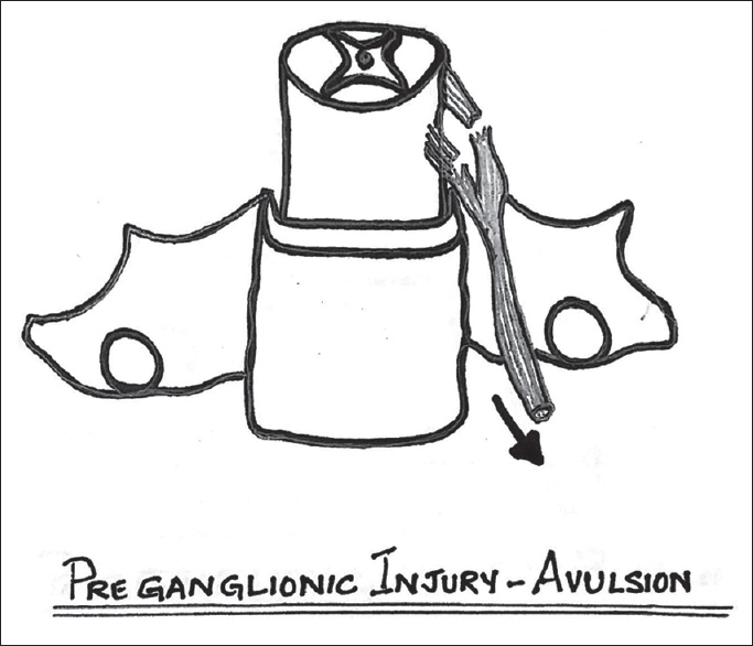 Schematic diagram of preganglionic avulsion of the rootlets from the spinal cord.