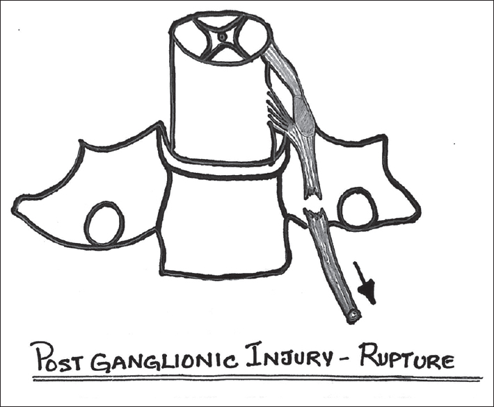 Schematic diagram of postganglionic rupture of the nerve beyond the dorsal root ganglion.