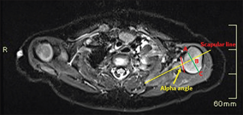 A case of brachial plexus birth palsy. MRI in a three-month-old infant at the level of left shoulder joint with drawings to assess GHD. Axial image shows scapular line (yellow) drawn on the body of scapula bisecting the midpoint of the glenoid surface (red line). The alpha angle is subtracted from 90° to get an angle of glenoid version. Humeral head coverage is measured by extending scapular line through the humeral head and a bisecting line drawn at midpoint of the humeral head (green line). The humeral head anterior to scapular line is the percentage of humeral head coverage calculated by the formula: AB/AC X 100%.