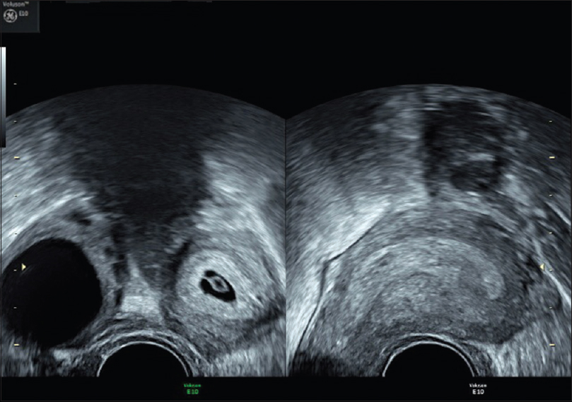 A 23-year-old woman approached us with 1½ months of amenorrhea and a positive urine pregnancy test. A transvaginal two-dimensional image showed the presence of intrauterine gestational sac in the right horn with yolk sac and a corpus luteum cyst in the ipsilateral ovary. A nonpregnant horn on the left side was observed. Nonpregnant horn shows the typical shape of the uterus with extreme lateral flexion.