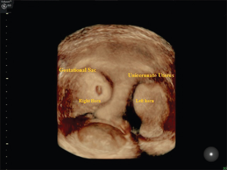 Three-dimensional ultrasound in coronal view clearly demonstrates unicornuate uterus on the left side and presence of pregnancy in the right horn. Myometrium surrounding the gestational sac with no thinning and no communication between the two horns. There is no continuity between the cavities containing the gestational cavity with the cervical canal.