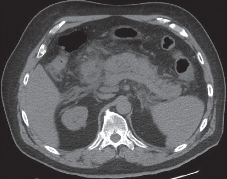 Noncontrast axial computed tomography of the abdomen demonstrating characteristic findings of acute pancreatitis, including indistinct pancreatic margins, edema, and fat stranding.