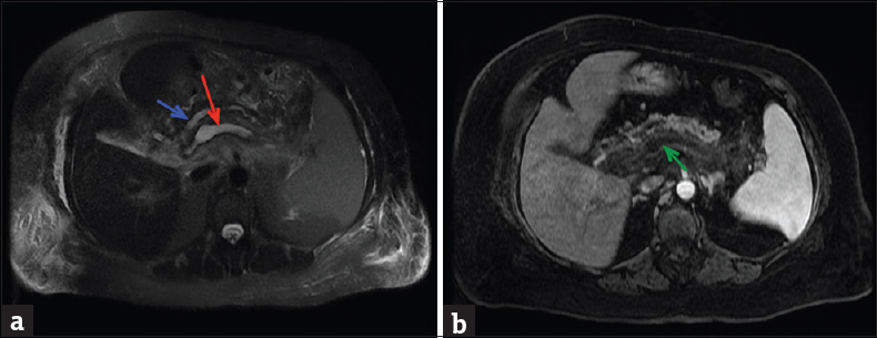 (a) Axial fat-suppressed T2-weighted image demonstrating a dilated fluid-filled pancreatic duct (blue arrow) anterior to a T2-hyperintense tubular structure [red arrow] which on the axial fat-saturated postcontrast T1-weighted image (b) corresponds to an expanded portal confluence lacking normal enhancement and containing a filling defect consistent with portal venous thrombosis (green arrow).