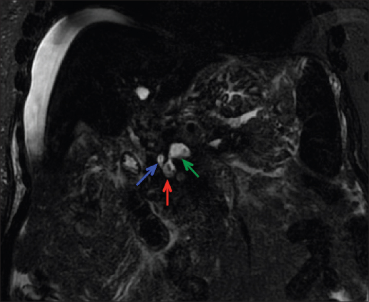 Coronal magnetic resonance cholangiopancreatography image demonstrating fistulization between the portal vein (green arrow), pseudocyst (red arrow), and pancreatic duct (blue arrow).