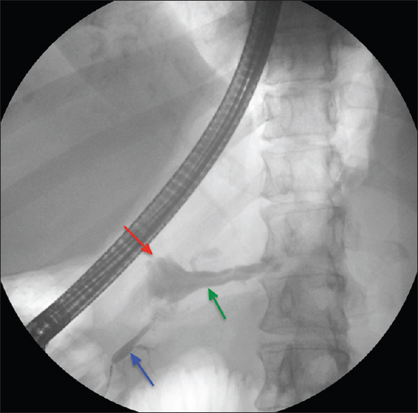 Endoscopic retrograde cholangiopancreatography fluoroscopic image demonstrating cannulation of the pancreatic duct (blue arrow) with abnormal contrast passage into the portal vein (green arrow) and associated intervening pseudocyst (red arrow) confirming the presence of the pancreatic-portal vein fistula.