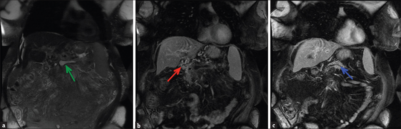 (a) Coronal fat-suppressed T2-weighted image demonstrating hyperintense fluid signal in the splenoportal confluence (green arrow) (b) Coronal fat-suppressed post-contrast T1-weighted image demonstrating nonenhancement of the portal venous confluence, consistent with thrombosis. Numerous enhancing collaterals (red arrow) are present in the porta hepatis region confirming the chronic nature of the thrombus and cavernous transformation of the portal vein. (c) A more posterior coronal fat-suppressed postcontrast T1-weighted image revealing a prominent pancreatic duct (blue arrow).
