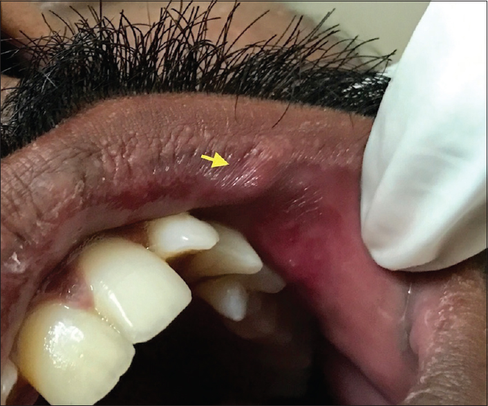 A 24-year-old male with soft pulsating nodule on the left vermilion of the upper lip (arrow).