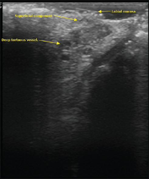 Longitudinal view sonographic image shows tortuous course of superior-labial artery branch from deeper layers to superficial mucosal component.