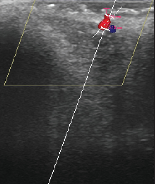 Ultrasound image shows the arterial location at 0.9 mm below the mucosal surface with a diameter of 1 mm transversely.