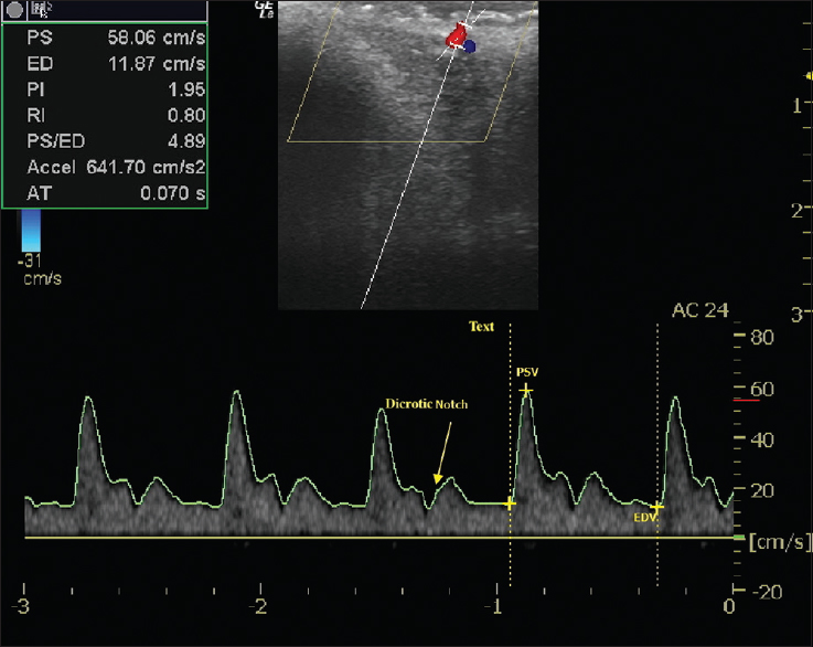 Spectral measurements reveal high resistance and flow velocity with a dicrotic notch in the superior-labial artery branch, left side. PSV: Peak systolic velocity, EDV: End-diastolic velocity).