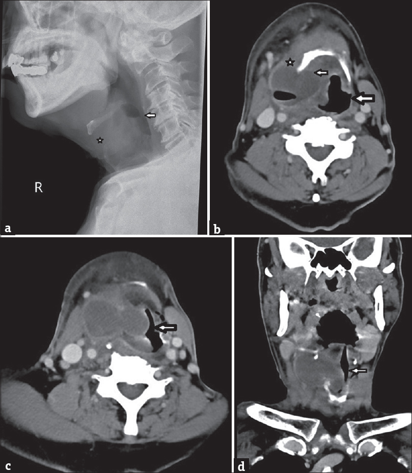 (a) A 75-year old patient with mixed-type laryngopyocele presented with fever, right neck swelling, and shortness of breath. Plain lateral neck radiograph demonstrated air-fluid level (arrow) and swelling (asterisk) over the upper cervical paralaryngeal soft tissues, (b) Axial contrast-enhanced computed tomography image revealed cystic lesion with internal gas pockets and enhancing wall in the supraglottic region with epicenter at the right thyrohyoid membrane. It spanned medially (small arrow) and laterally (asterisk) to the hyoid bone crossing thyrohyoid membrane. Mass effect was noted with narrowing of the larynx (large arrow). The overall features were suggestive of a mixed-type laryngopyocele complicating airway obstruction (c and d) Axial and coronal contrast-enhanced computed tomography images showed marked narrowing of airway (arrow) by compressive effect of laryngopyocele. With signs of stridor and airway obstruction, subsequent intubation was performed for this patient.