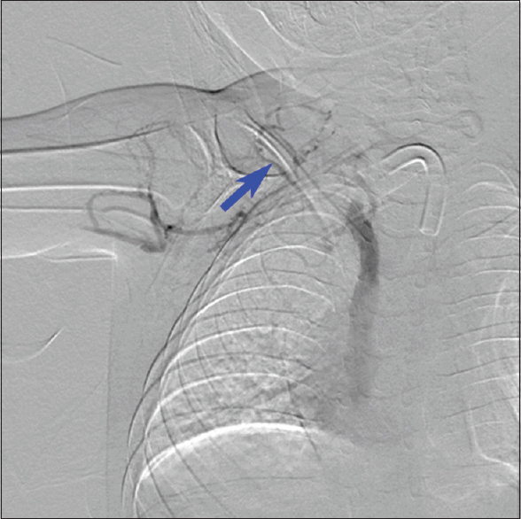 A 5-year-old female with Waardenburg syndrome presented for peripherally inserted central catheter placement for total parental nutrition. Digital subtraction venography of the right upper extremity showing chronic total occlusion of the right axillary and subclavian veins (blue arrow).