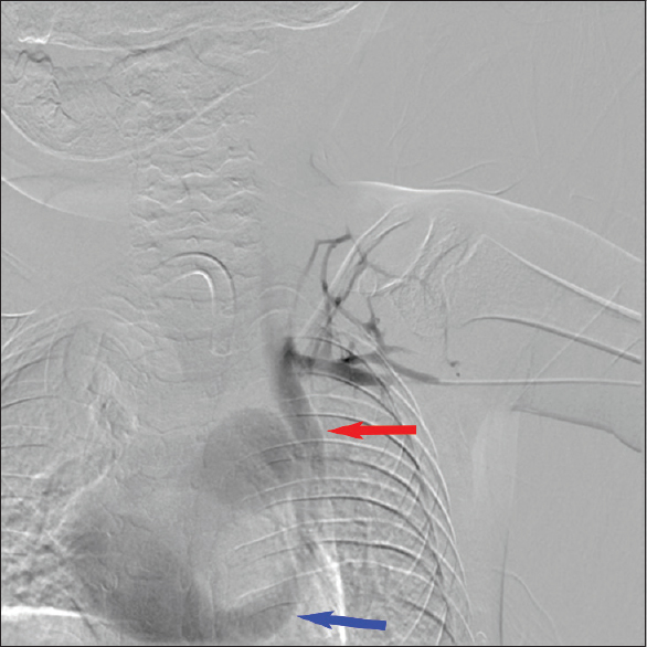 Digital subtraction venography of the left upper extremity showing patient's cephalic arch and subclavian vein draining into a left-sided superior vena cava (red arrow). Left-sided superior vena cava drains to the right atrium via the coronary sinus (blue arrow).