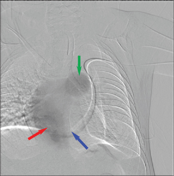 Peripherally inserted central catheter line catheter tip (blue arrow) venogram within the coronary sinus (red arrow) showing the right atrium and the main pulmonary artery truck (green arrow).