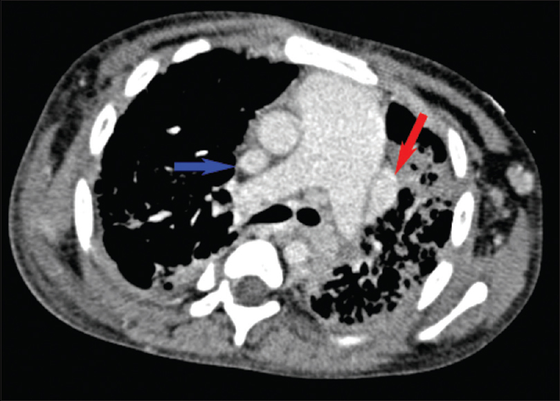 Axial contrast-enhanced chest computed tomography showing duplicated superior vena cava (blue and red arrows) and an enlarged pulmonary artery trunk.