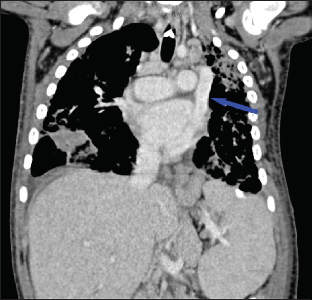 Coronal contrast-enhanced chest computed tomography showing a left-sided superior vena cava (blue arrow).