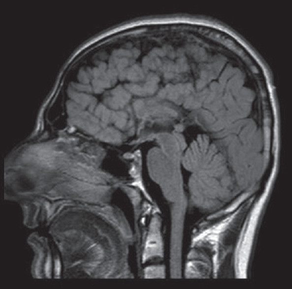 Sagittal fluid-attenuated inversion recovery image delineates corpus callosum hypogenesis. The rostrum, genu, and splenium are absent while remnant of the body seems as a short thin line. Note polymicrogyria in the frontal lobe.