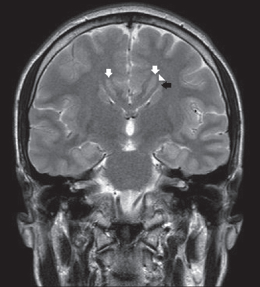 Corpus callosum is absent in this coronal T2-weighted section through thalami. Lateral ventricles are slit like and small in caliper. They are upturned (black arrow) and there are Probst bundles (arrowhead), secondary to callosal hypogenesis. Note bilateral periventricular nodular gray matter heterotopia (white arrows).