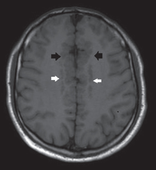 Axial T1-weighted image shows bifrontal parasagittal polymicrogyria (black arrows) and bilateral periventricular nodular gray matter heterotopia (white arrows).