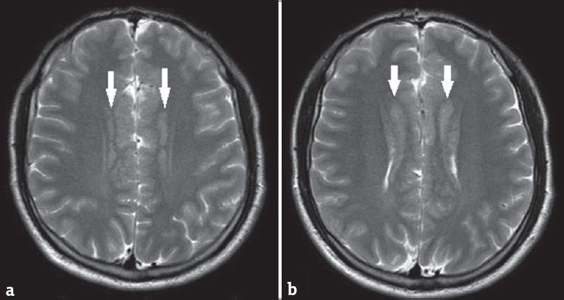 Subsequent axial T2-weighted images clearly delineate bilateral periventricular gray matter heterotopia (white arrows). Note bifrontal parasagittal polymicrogyria (a and b).