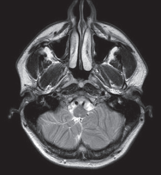 Axial T2-weighted image demonstrates abnormal cerebellar foliation and fissuration with loss of the normal architecture in the inferior aspect of the cerebellar hemispheres, consistent with cerebellar dysplasia.