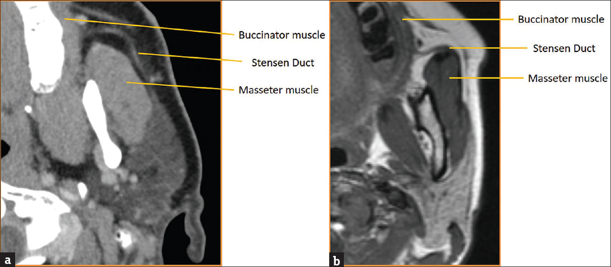 Parotid (Stensen) duct anatomy. (a) Axial computed tomography of parotid duct anatomy with key landmarks labeled. (b) Axial T2-weighted magnetic resonance image of parotid duct anatomy with key landmarks labeled.