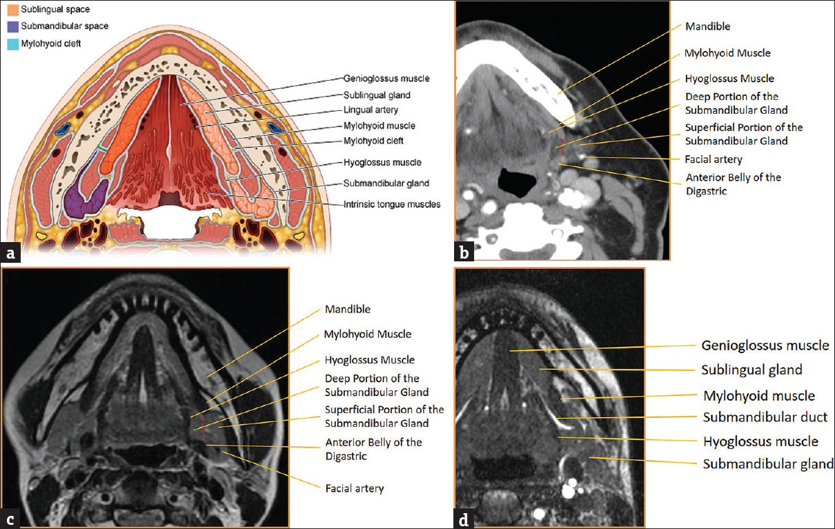 Submandibular space anatomy. (a) Illustration of submandibular and sublingual space anatomy with key landmarks labeled. (b) Axial computed tomography of submandibular space anatomy with key landmarks labeled. (c) Axial T2-weighted magnetic resonance image of submandibular space anatomy with key landmarks labeled. (d) Axial T2-weighted magnetic resonance image of submandibular duct anatomy with key landmarks labeled.