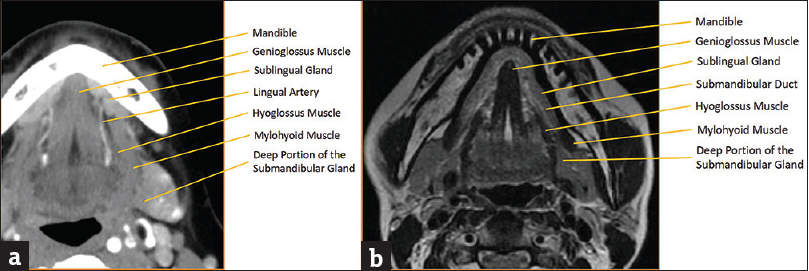 Sublingual space anatomy. (a) Axial computed tomography of sublingual space anatomy with key landmarks labeled. (b) Axial T2-weighted magnetic resonance imaging image of sublingual space anatomy with key landmarks labeled.