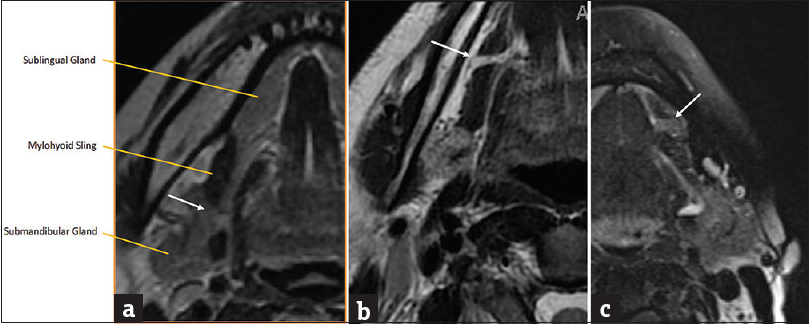 Mylohyoid sling/cleft. (a) Axial T2-weighted magnetic resonance image demonstrates the mylohyoid sling with normal free communication posteriorly between submandibular and sublingual spaces (white arrow). (b) Axial T2-weighted magnetic resonance image demonstrates a fat-filled mylohyoid cleft (white arrow). (c) Axial T2-weighted magnetic resonance imaging image demonstrates a mylohyoid cleft containing herniated sublingual gland (white arrow).