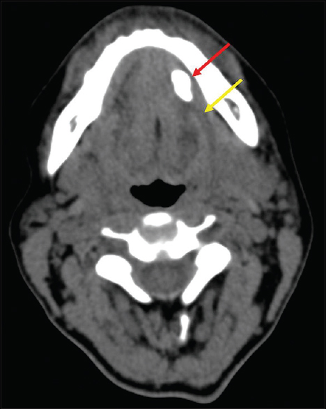 Sialolithiasis – computed tomography. Axial computed tomography image demonstrates a submandibular duct sialolith (red arrow) with dilated proximal duct (yellow arrow).