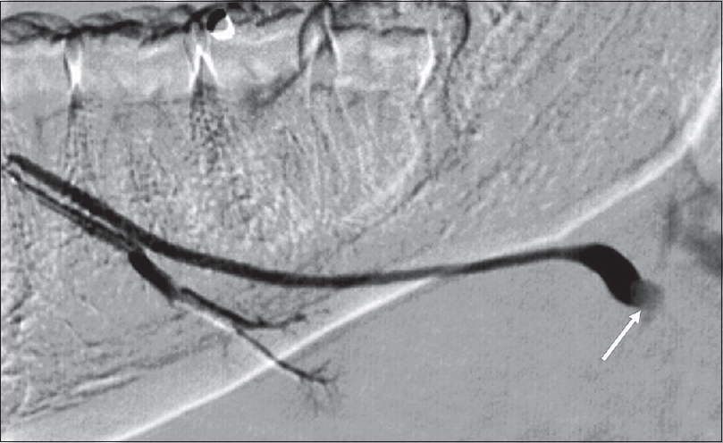 Sialolithiasis – Sialography. Right submandibular duct sialogram in a 36-year-old female demonstrates a filling defect (white arrow) at the expected location of the hilum of the submandibular gland, compatible with a calculus.