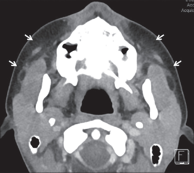 Viral Sialadenitis. Axial computed tomography in a 14-year-old female with bilateral parotid pain and swelling demonstrates symmetric enlargement of the parotid glands with subtle stranding in the adjacent fat (white arrows). Blood work was positive for parainfluenza virus.