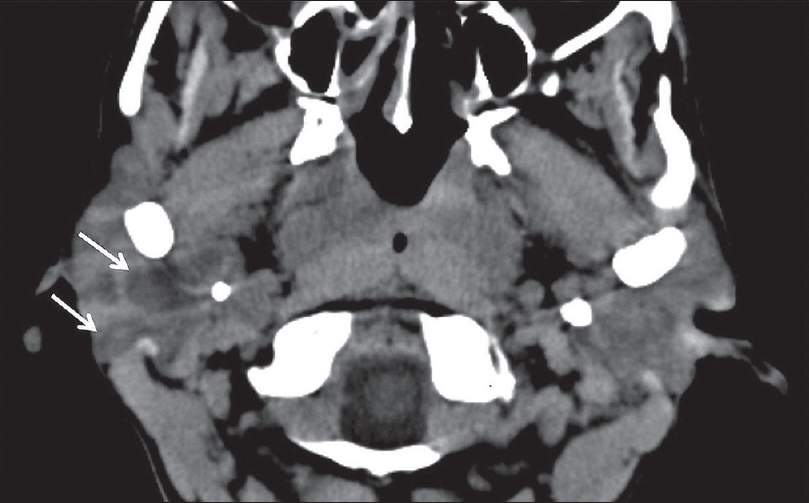 HIV Sialadenitis. A 44-year-old female with HIV not on highly active antiretroviral therapy (CD4 109) presenting with 1 month of progressive painless bilateral parotid swelling. Axial computed tomography demonstrates heterogeneous attenuation throughout the parotid glands with prominent cystic lesions (white arrows), benign lymphoepithelial cysts.